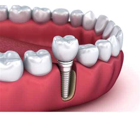 dental implants yuba city